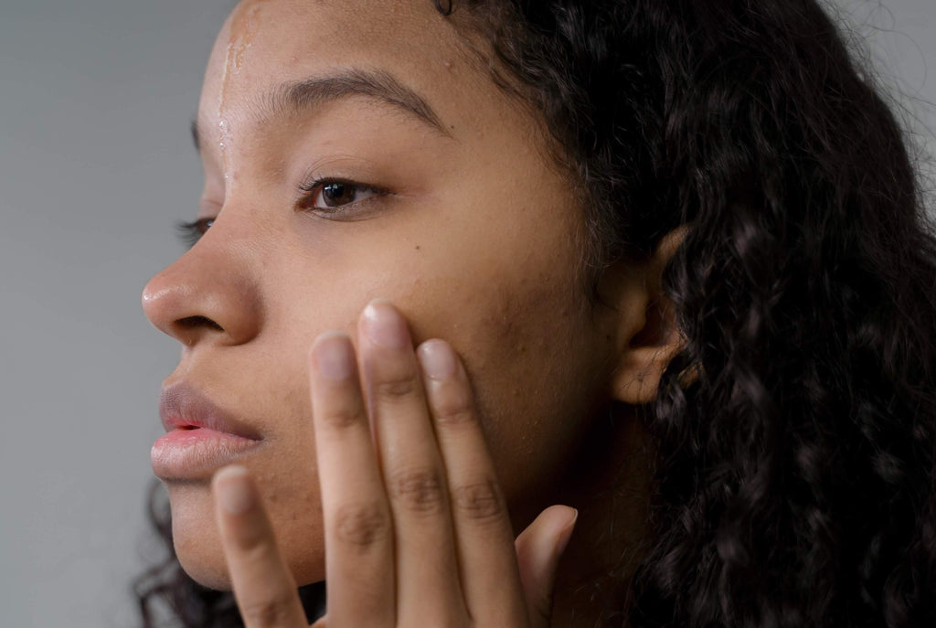 brunette woman with acne